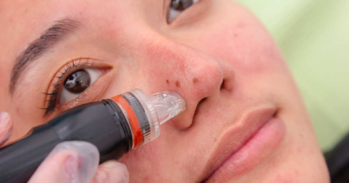Close-up of a person receiving a HydraFacial treatment on the nose to remove blackheads and cleanse pores in Atlanta GA