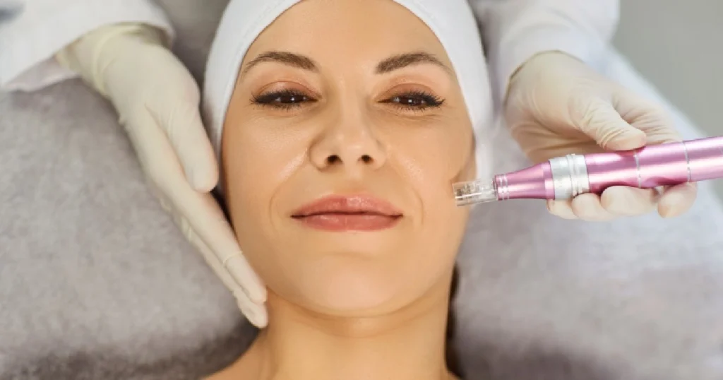 Women receiving Microneedling treatment inTucker, GA